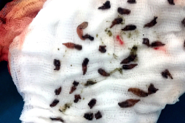 Gắp bỏ cả ngàn con sán lá gan trong ống mật bệnh nhân - Ảnh 2.