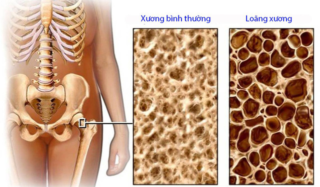 Tai biến do lạm dụng corticoid - Ảnh 1.