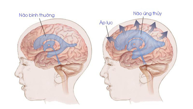 Não úng thủy ở trẻ em - Ảnh 1.