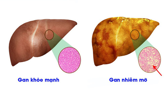 Hiểu đúng về bệnh gan nhiễm mỡ - Ảnh 1.