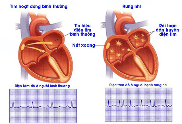 Rung nhĩ: Những điều người bệnh tim cần biết - Ảnh 1.