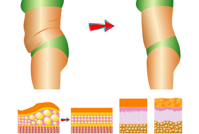 4. Các phương pháp giảm mỡ phổ biến