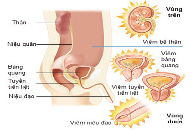 Dấu hiệu của viêm đường tiết niệu - Ảnh 1.