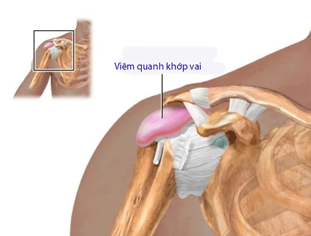 Viêm quanh khớp vai thể đông đặc - Ảnh 1.