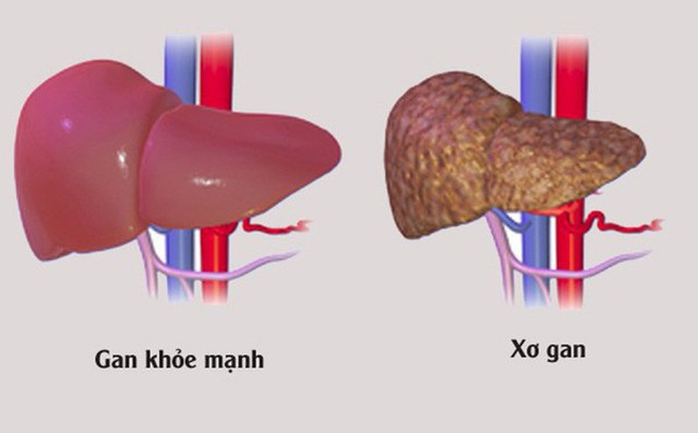 Biến chứng của xơ gan - Ảnh 1.