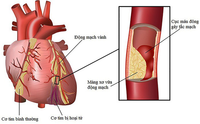Yếu tố gây nên bệnh lý nhồi máu cơ tim hay bệnh vành tim - Ảnh 1.
