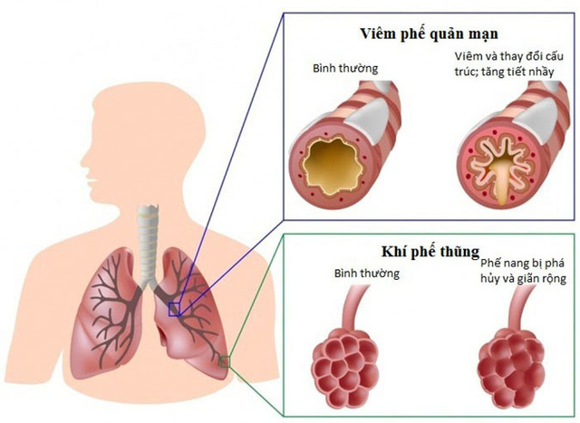 Ai có nguy cơ mắc bệnh phổi tắc nghẽn mạn tính? - Ảnh 1.