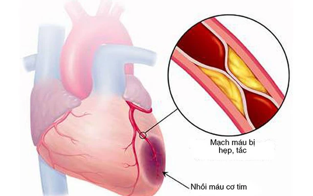 Biến đổi hệ tim mạch ở người cao tuổi và bệnh lý gây nên - Ảnh 1.
