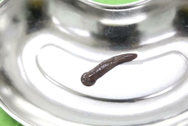 Đỉa trâu gần 10cm sống trong cổ họng bệnh nhân nhiều ngày - Ảnh 2. Đỉa trâu gần 10cm sống trong cổ họng bệnh nhân nhiều ngày - Ảnh 2.