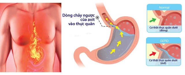 Sự khác biệt giữa chứng ợ nóng và bệnh tim mạch - Ảnh 1. Sự khác biệt giữa chứng ợ nóng và bệnh tim mạch - Ảnh 1.