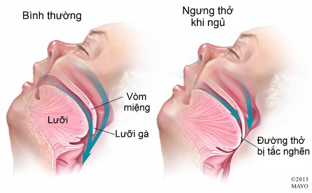 Ngáy to vô lo hay đáng lo? - Ảnh 1.
