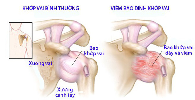 Viêm bao dính khớp vai - Ảnh 1.