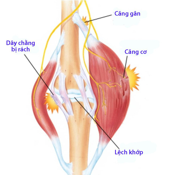 4 nhóm chấn thương thể thao thường gặp nhất - Ảnh 1.