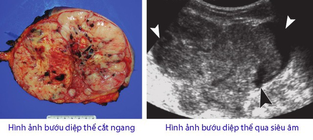 Bướu diệp thể ở vú. - Ảnh 1. Bướu diệp thể ở vú. - Ảnh 1.