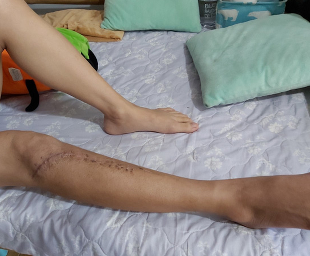 Điều tra vụ nữ kế toán cũ nghi bị đánh gãy chân ở văn phòng công ty - Ảnh 2.