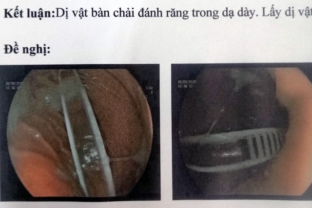 Gắp bàn chải đánh răng dài gần 20cm khỏi dạ dày bé gái 13 tuổi - Ảnh 1.