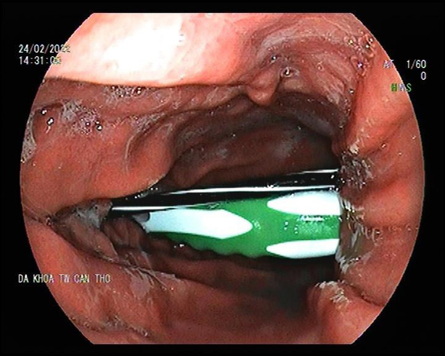 Nội soi lấy ruột bút bi và bàn chải trong dạ dày nam bệnh nhân ...