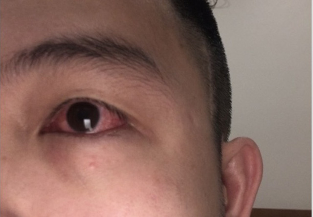 F0 bị đỏ mắt: Triệu chứng không nên chủ quan - Tuổi Trẻ Online
