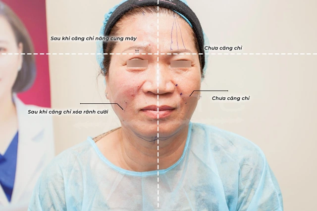 Bác sĩ Nguyễn Phương Thảo giải đáp những điều cần biết về căng da bằng chỉ - Ảnh 2.