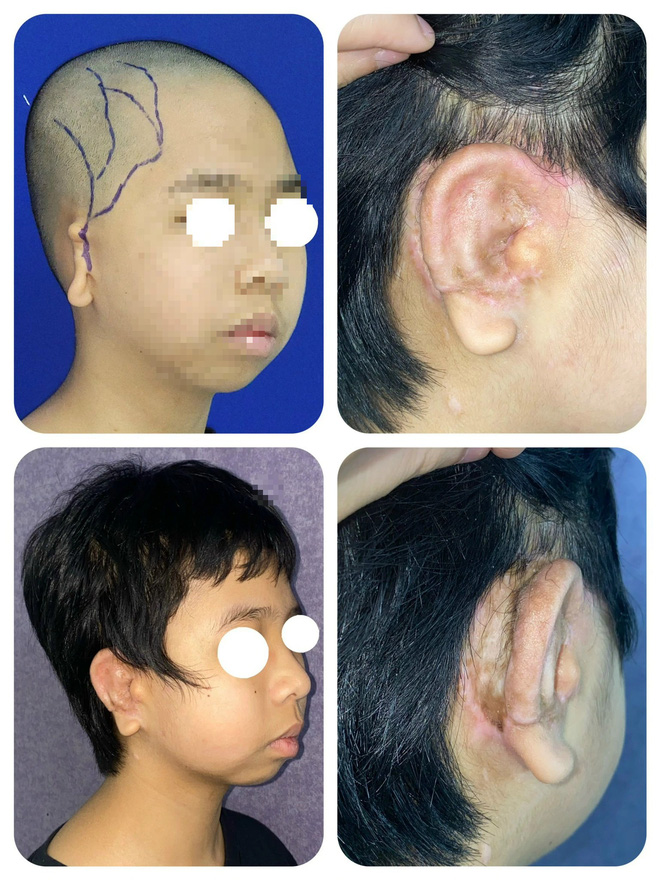 Bé trai lép nửa mặt, dị tật tai nhỏ được phẫu thuật thành công- Ảnh 1.