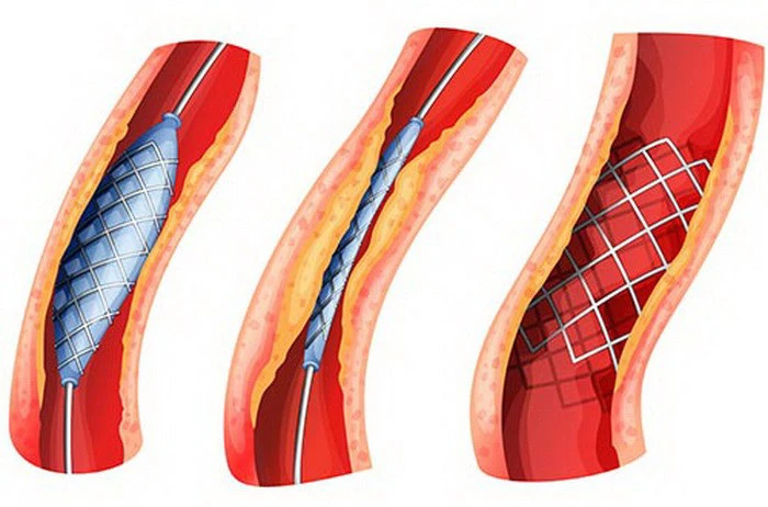 Sáng chế mới trong điều trị tắc nghẽn mạch máu - Ảnh 2.