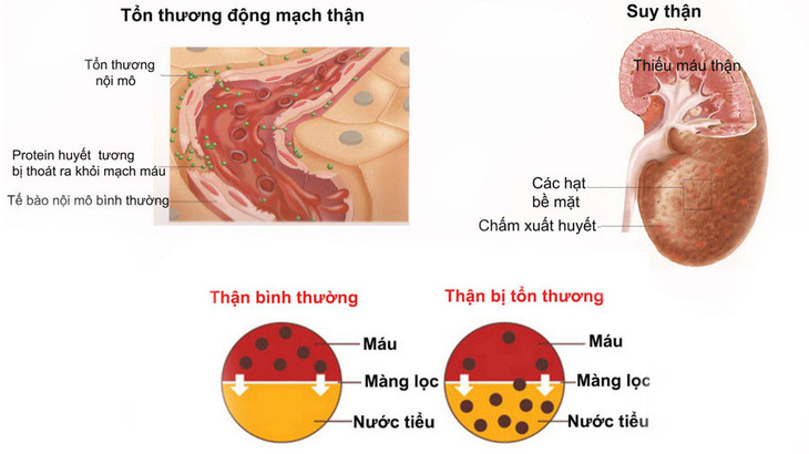 Những biến chứng nguy hiểm của bệnh sỏi thận, bạn có biết?