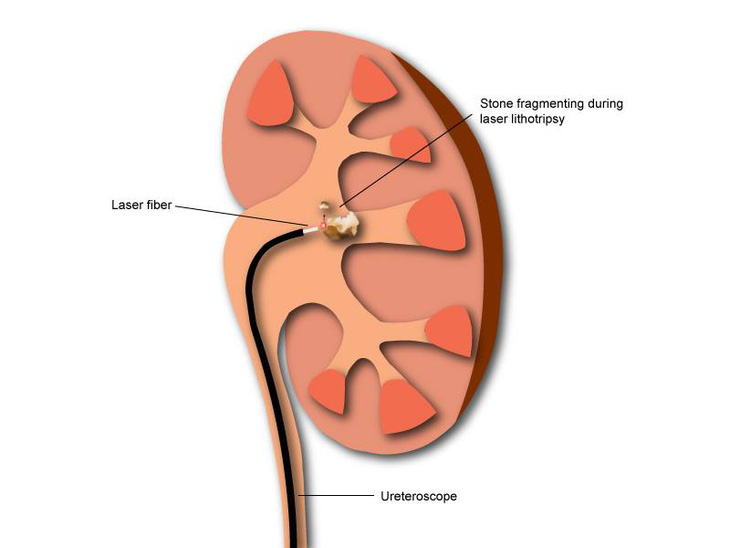 Lấy sỏi thận sao cho nhanh, ít di chứng? - Ảnh 1.