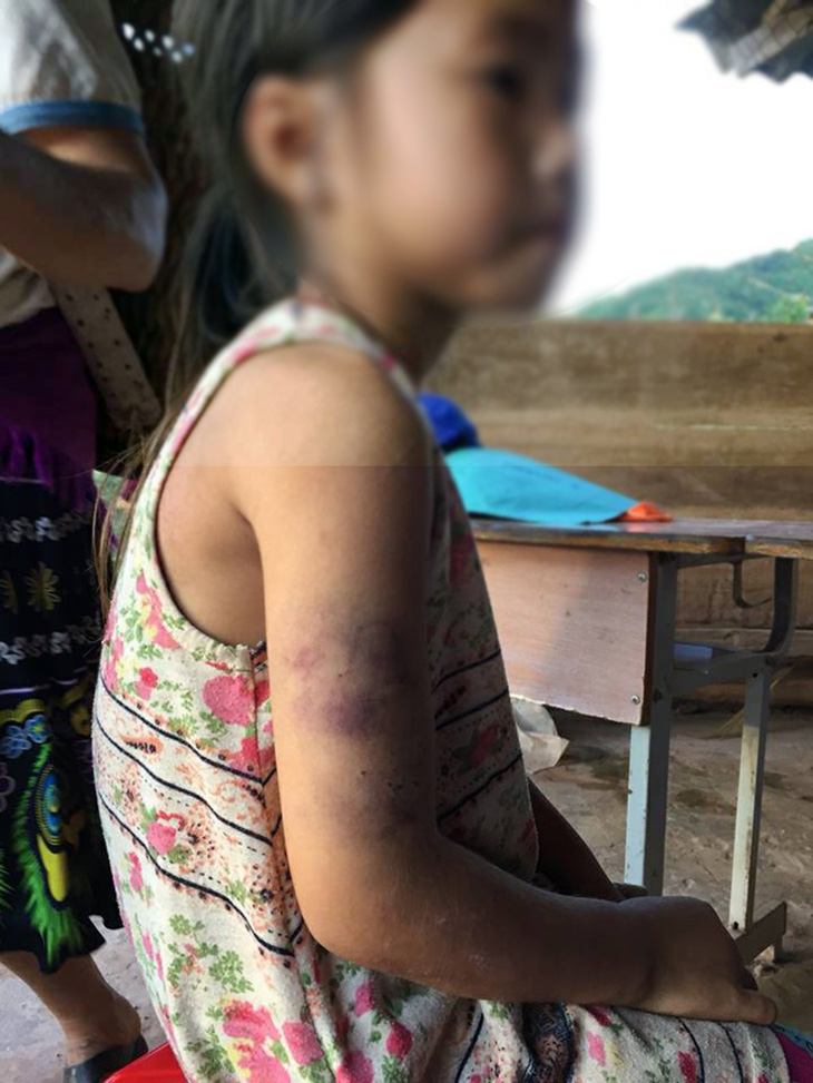 Học sinh lớp 2 bị cô đánh bầm tím vì chữ viết xấu - Ảnh 1.