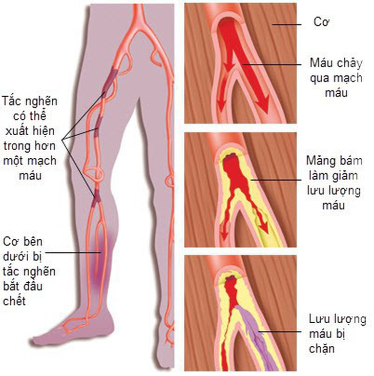 Tắc động mạch ngoại biên: âm thầm nhưng nguy hiểm - Ảnh 1.