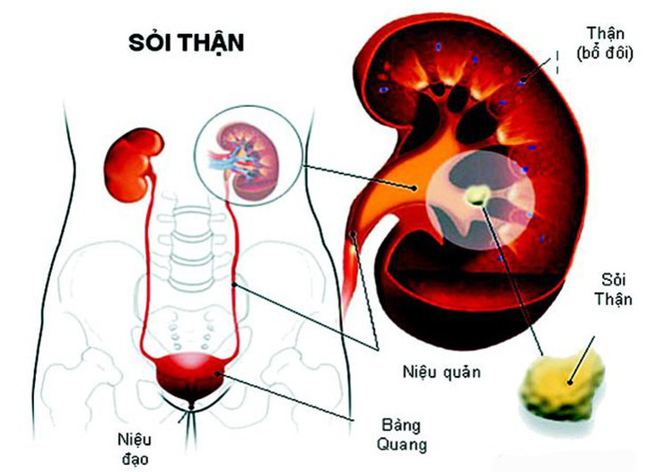 Biến chứng sỏi thận