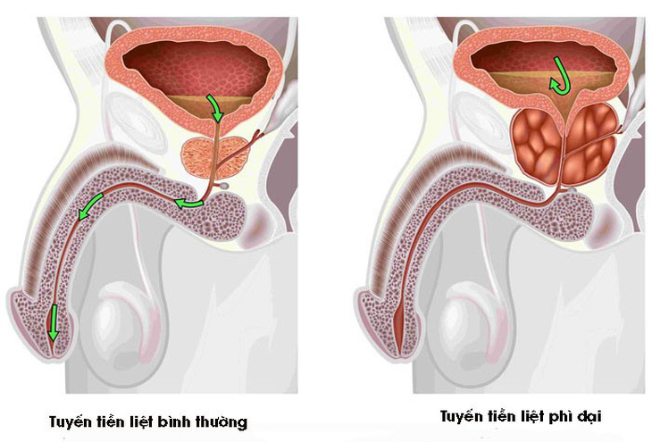 U xơ tuyến tiền liệt - nỗi lo của nam giới tuổi trung niên - Ảnh 1.