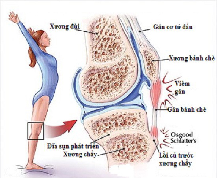 Vài điều cần biết về viêm gân bánh chè - Ảnh 1.