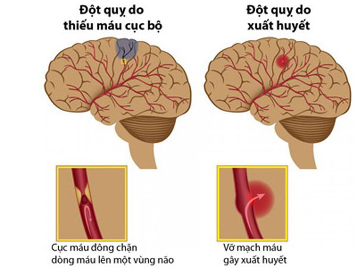 Những điều cần biết về đột quỵ não - Ảnh 1.