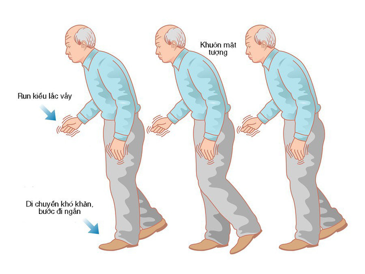 Những điều cần biết về bệnh Parkinson - Ảnh 1.