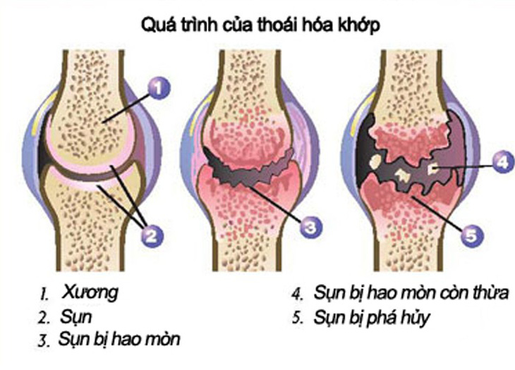 Giảm tiến trình thoái hóa khớp - Ảnh 1.