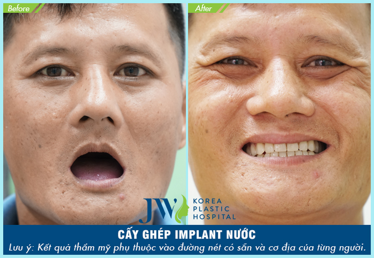 Trải nghiệm công nghệ cấy ghép Implant Thế giới tại Việt Nam - Ảnh 4.