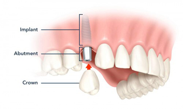 Kỹ thuật cấy ghép răng giả cùng lúc nhổ răng thật - Ảnh 1.