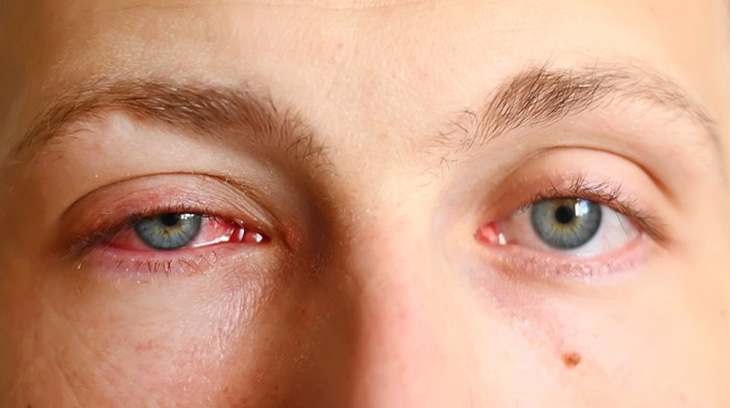 Bệnh đau mắt đỏ và các biện pháp phòng ngừa - Ảnh 1.