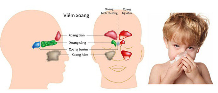 Viêm xoang mạn tính kéo dài do trào ngược dạ dày-thực quản - Ảnh 1.