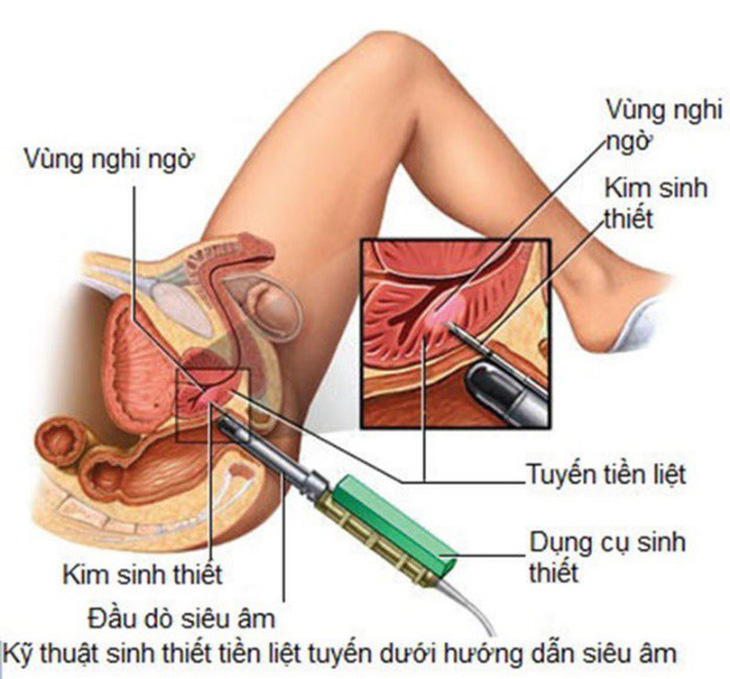 Ung thư tuyến tiền liệt - Ảnh 1.