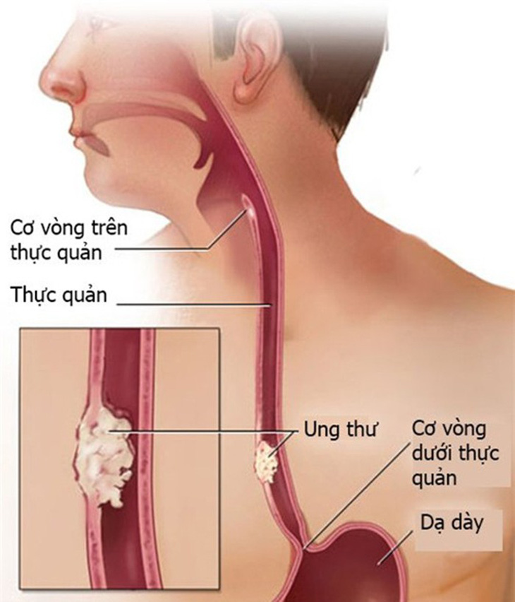 Nuốt khó là triệu chứng thường gặp của ung thư thực quản - Ảnh 1.