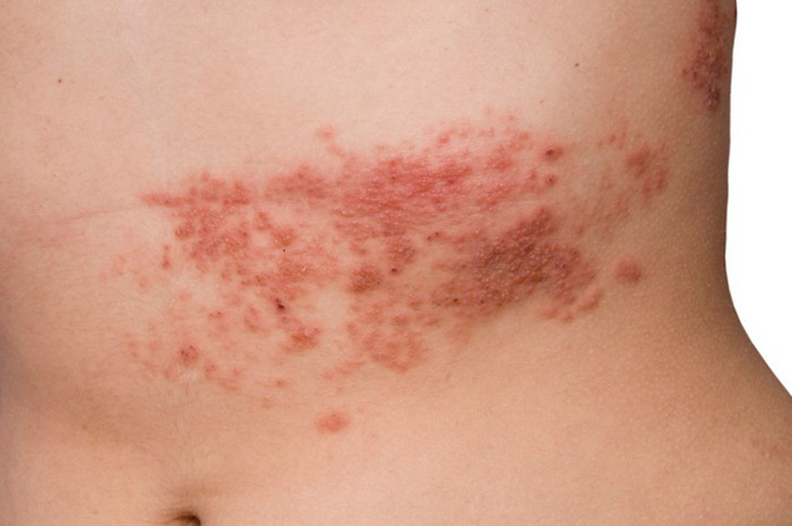 Một số bệnh da do virus thường gặp - Ảnh 1.