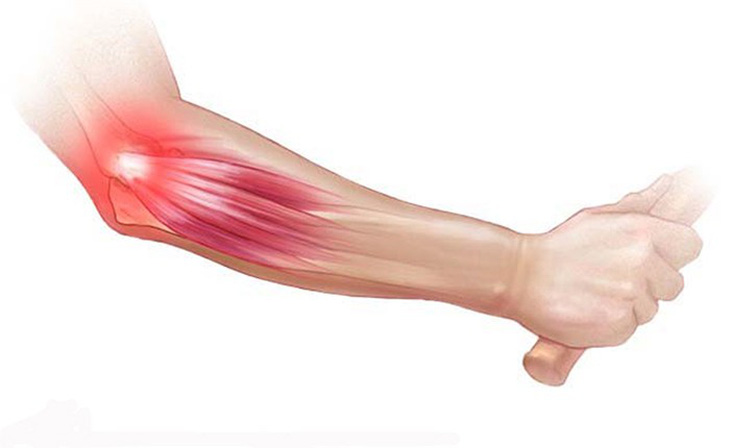 Hội chứng Tennis elbow - Ảnh 1.
