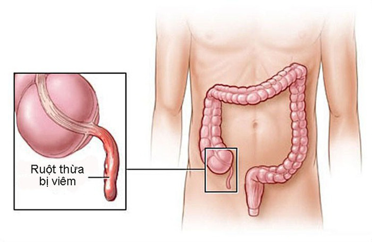 Những điều cần biết về viêm ruột thừa - Ảnh 1.