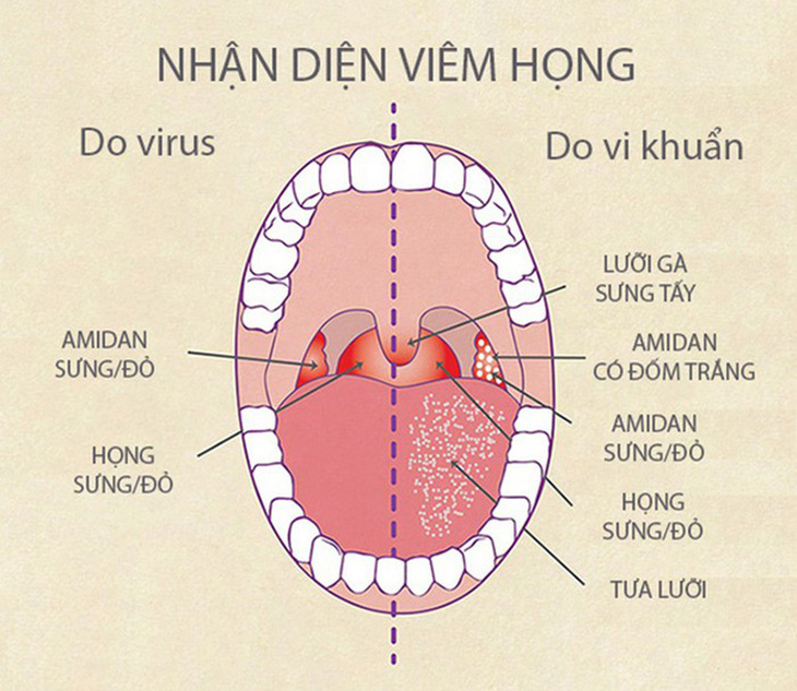 Bệnh viêm họng mùa lạnh - Ảnh 1.