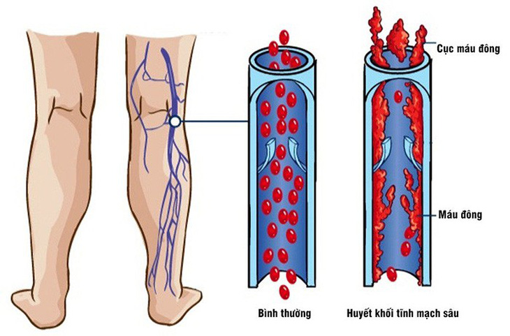 Những điều cần biết về bệnh huyết khối tĩnh mạch sâu - Ảnh 1.