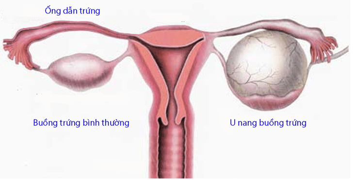 U nang buồng trứng - Ảnh 1.