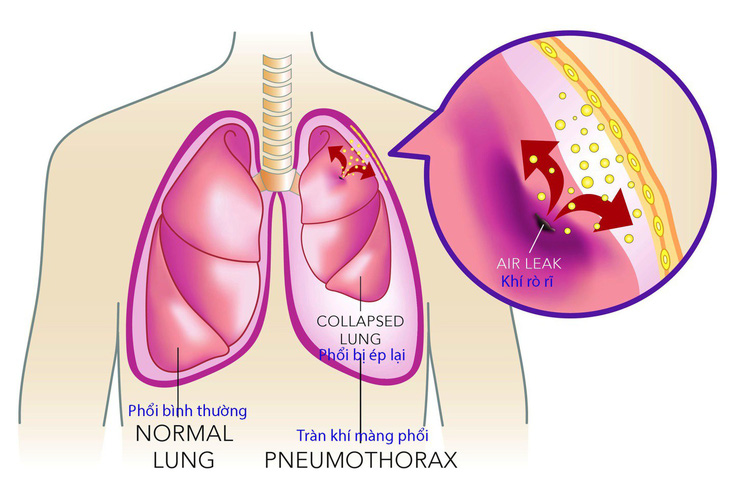 Tràn khí màng phổi tự phát - Ảnh 1.