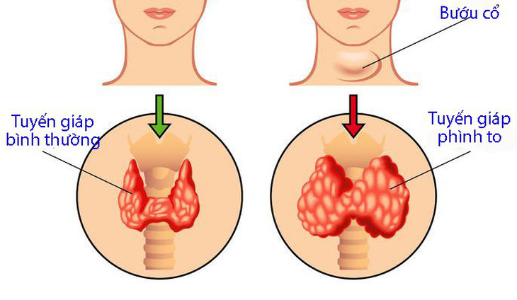 Bệnh bướu cổ có nên mổ? - Ảnh 1.