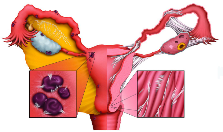 Lạc nội mạc tử cung - Ảnh 1.